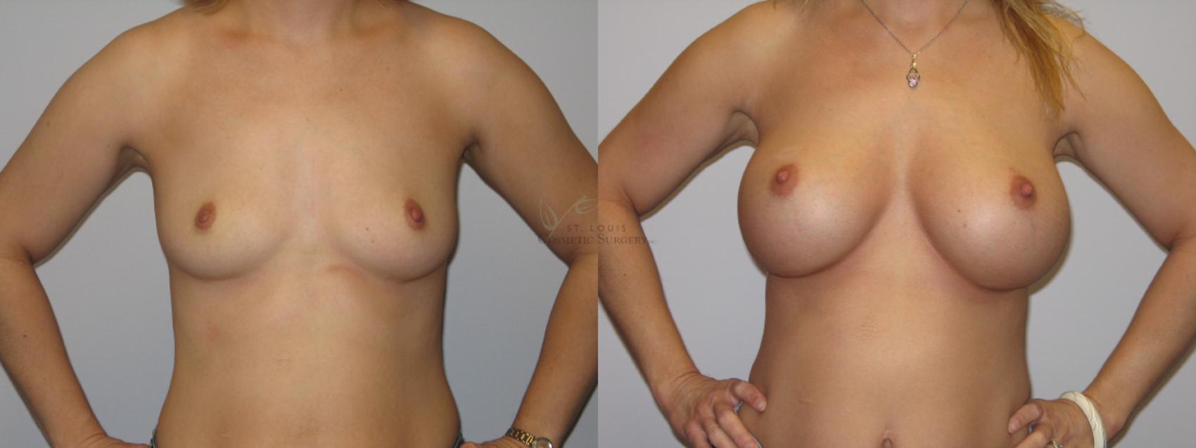 Before & After Breast Augmentation Case 4 View #1 View in St. Louis, MO