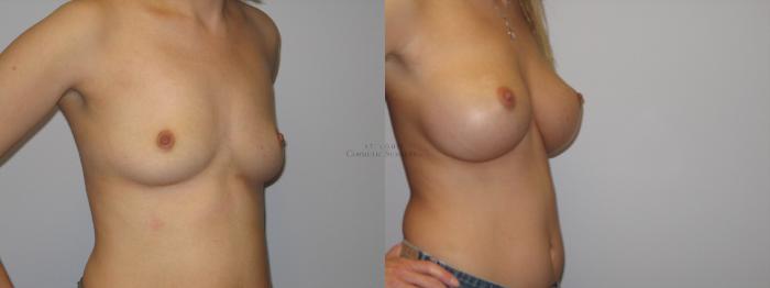 Before & After Breast Augmentation Case 4 View #2 View in St. Louis, MO