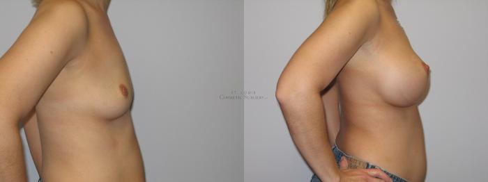 Before & After Breast Augmentation Case 4 View #3 View in St. Louis, MO
