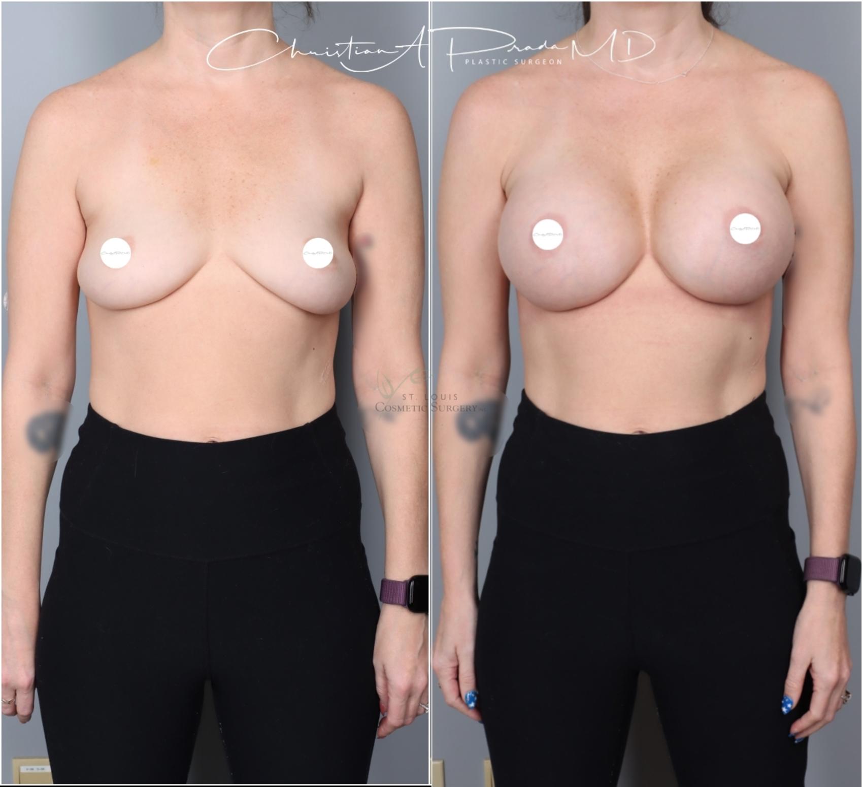 Before & After Breast Augmentation Case 403 Front View in St. Louis, MO