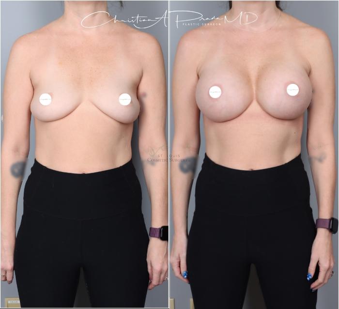 Before & After Breast Augmentation Case 403 Front View in St. Louis, MO