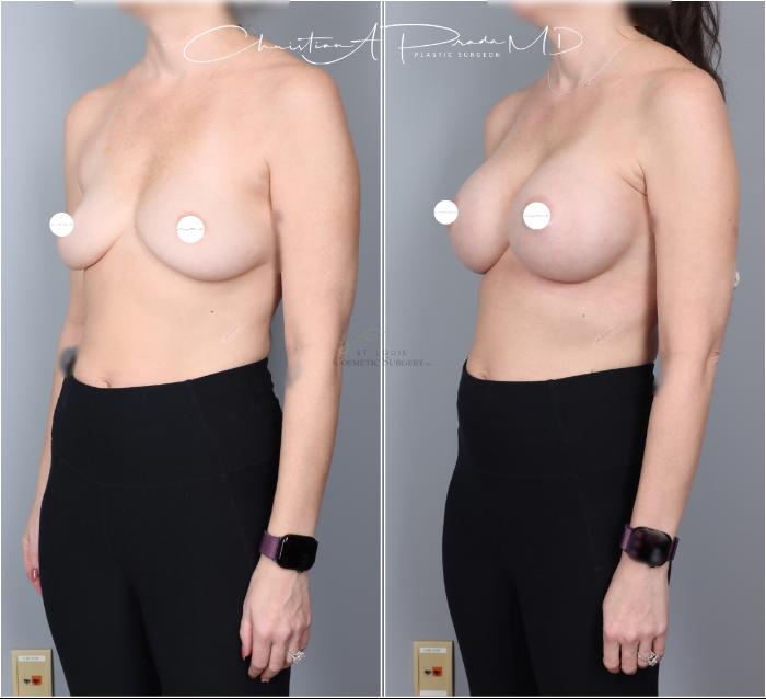 Before & After Breast Augmentation Case 403 Left Oblique View in St. Louis, MO