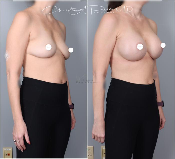 Before & After Breast Augmentation Case 403 Right Oblique View in St. Louis, MO