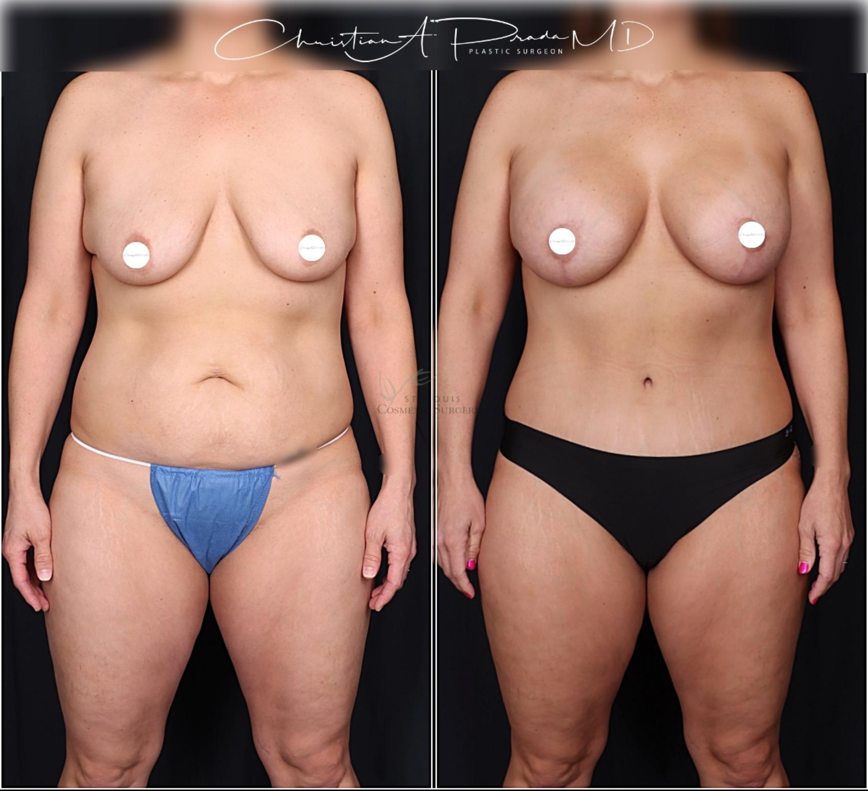 Before & After Tummy Tuck Case 406 Front View in St. Louis, MO