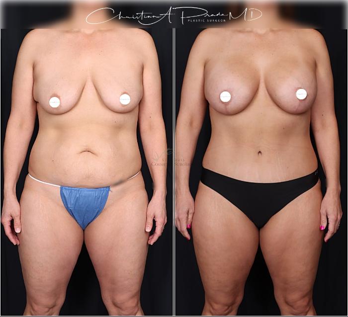 Before & After Tummy Tuck Case 406 Front View in St. Louis, MO