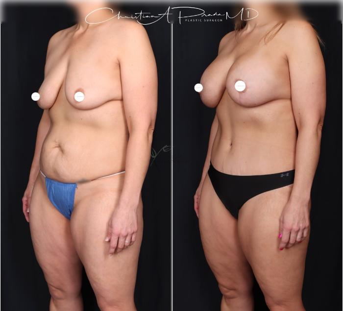 Before & After Tummy Tuck Case 406 Left Oblique View in St. Louis, MO