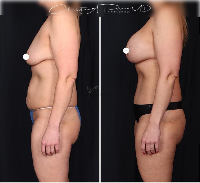 Before & After Tummy Tuck Case 406 Left Side View in St. Louis, MO