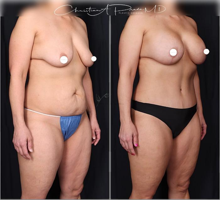 Before & After Tummy Tuck Case 406 Right Oblique View in St. Louis, MO