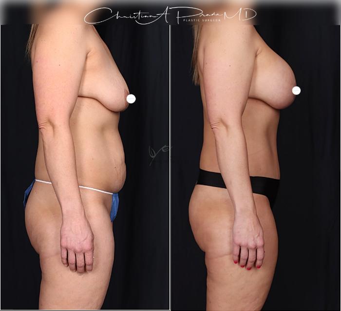 Before & After Tummy Tuck Case 406 Right Side View in St. Louis, MO