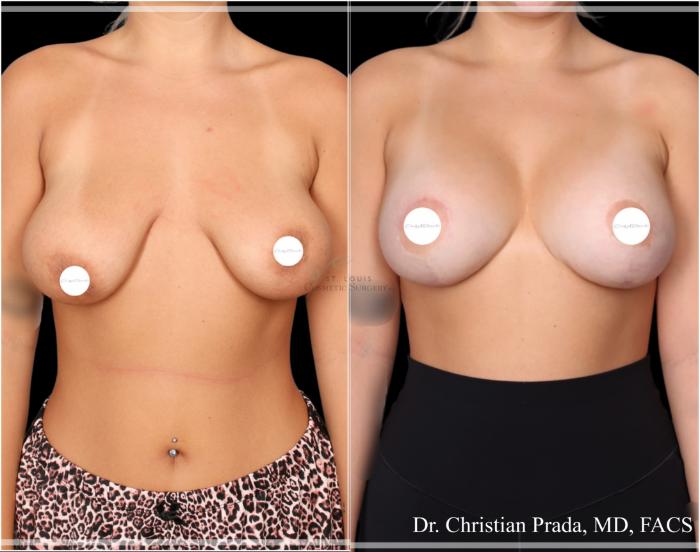 Before & After Breast Lift Case 407 Front View in St. Louis, MO
