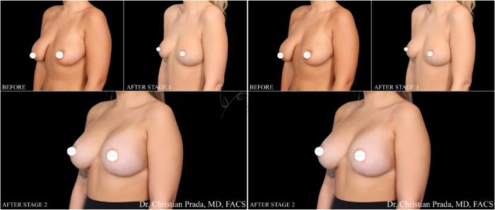 Before & After Breast Lift Case 407 Left Oblique View in St. Louis, MO