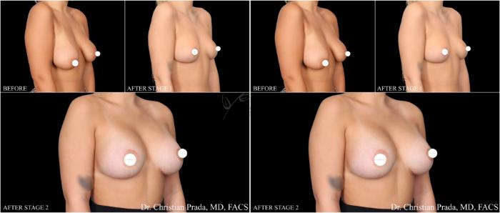 Before & After Breast Lift Case 407 Right Oblique View in St. Louis, MO