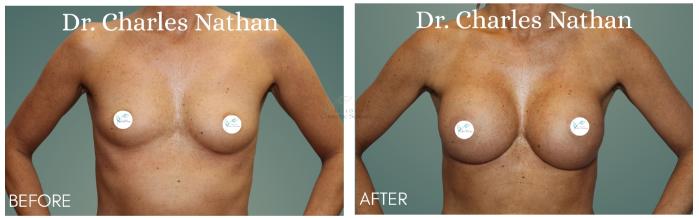 Before & After Breast Augmentation Case 408 Front View in St. Louis, MO