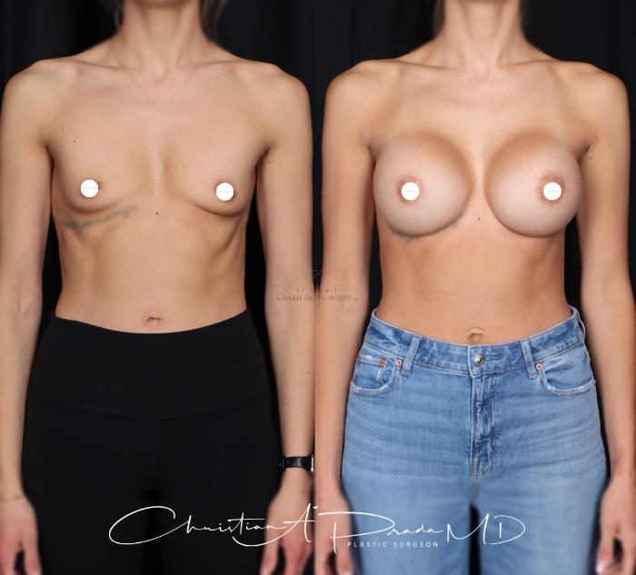 Before & After Breast Augmentation Case 412 Front View in St. Louis, MO