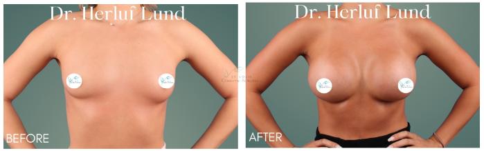 Before & After Breast Augmentation Case 413 Front View in St. Louis, MO