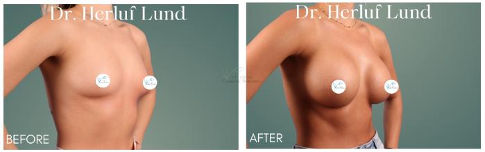 Before & After Breast Augmentation Case 413 Left Oblique View in St. Louis, MO