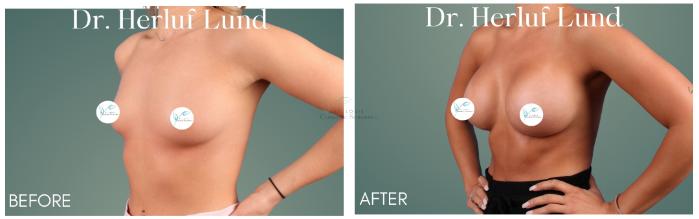 Before & After Breast Augmentation Case 413 Right Oblique View in St. Louis, MO