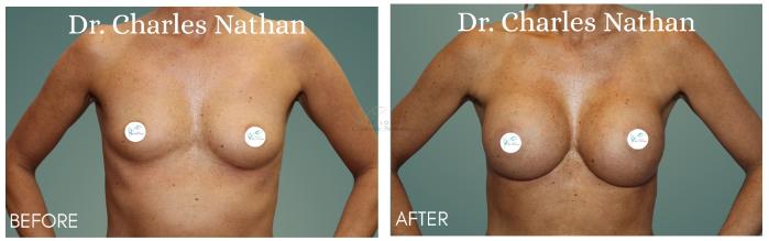 Before & After Breast Augmentation Case 414 Front View in St. Louis, MO