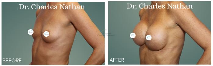 Before & After Breast Augmentation Case 414 Right Oblique View in St. Louis, MO