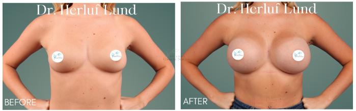 Before & After Breast Augmentation Case 415 Front View in St. Louis, MO