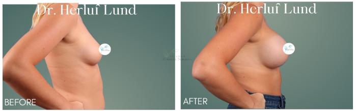 Before & After Breast Augmentation Case 415 Left Side View in St. Louis, MO