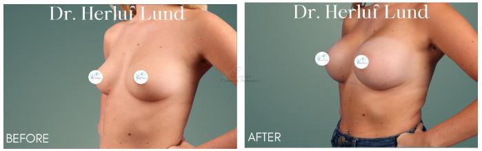 Before & After Breast Augmentation Case 415 Right Oblique View in St. Louis, MO