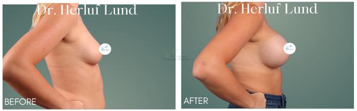 Before & After Breast Augmentation Case 418 Left Side View in St. Louis, MO