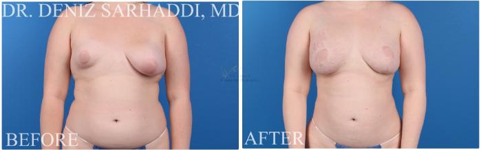 Before & After Breast Augmentation Case 422 Front View in St. Louis, MO