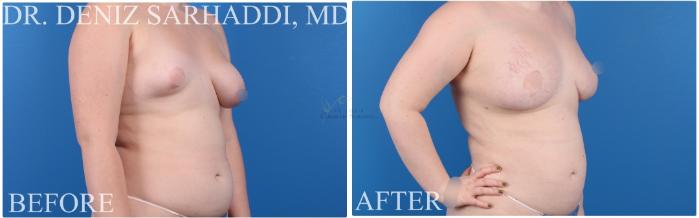 Before & After Breast Augmentation Case 422 Left Oblique View in St. Louis, MO