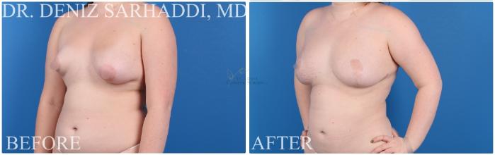 Before & After Breast Augmentation Case 422 Right Oblique View in St. Louis, MO