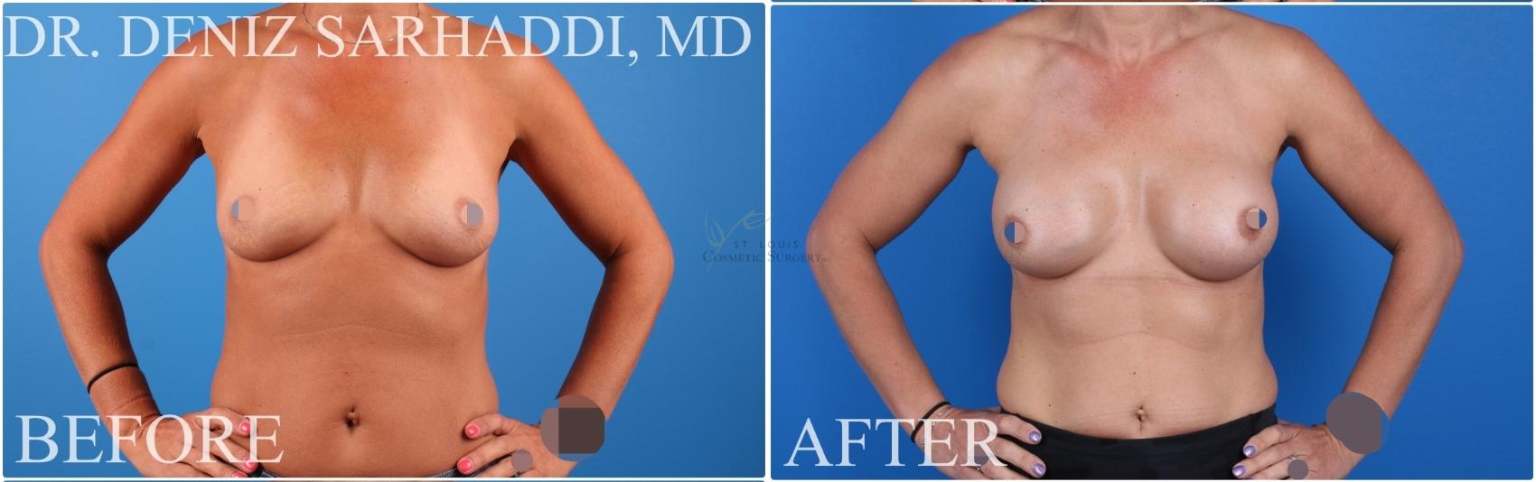 Before & After Breast Augmentation Case 423 Front View in St. Louis, MO