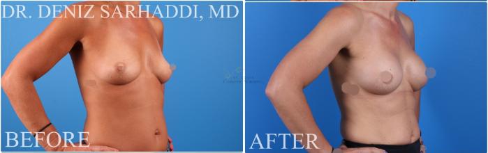 Before & After Breast Augmentation Case 423 Left Oblique View in St. Louis, MO