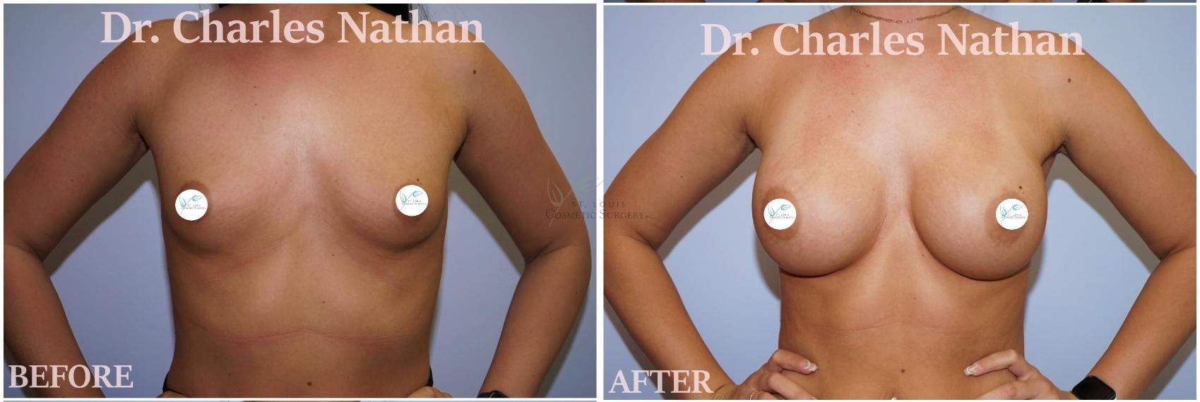 Before & After Breast Augmentation Case 424 Front View in St. Louis, MO