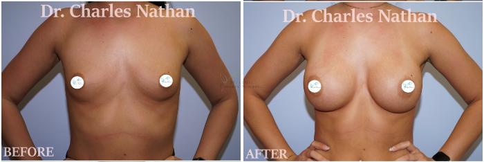 Before & After Breast Augmentation Case 424 Front View in St. Louis, MO