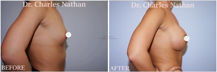 Before & After Breast Augmentation Case 424 Left Side View in St. Louis, MO