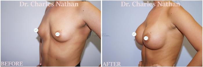 Before & After Breast Augmentation Case 424 Right Oblique View in St. Louis, MO