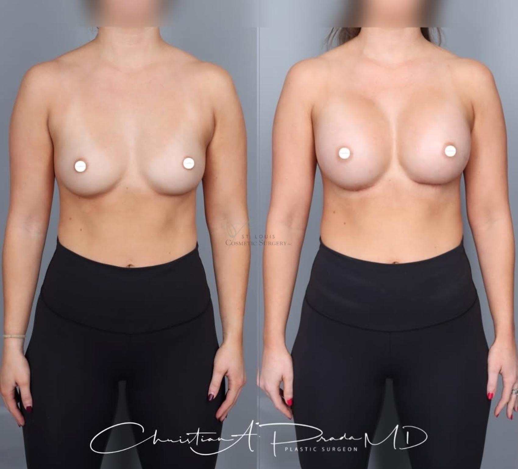 Before & After Breast Augmentation Case 430 Front View in St. Louis, MO