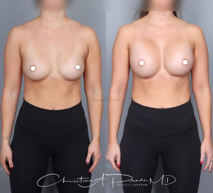 Before & After Breast Augmentation Case 430 Front View in St. Louis, MO