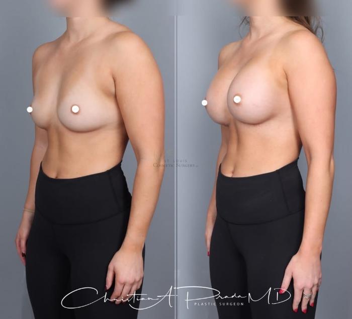 Before & After Breast Augmentation Case 430 Left Oblique View in St. Louis, MO