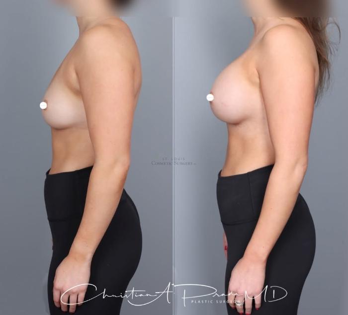 Before & After Breast Augmentation Case 430 Left Side View in St. Louis, MO