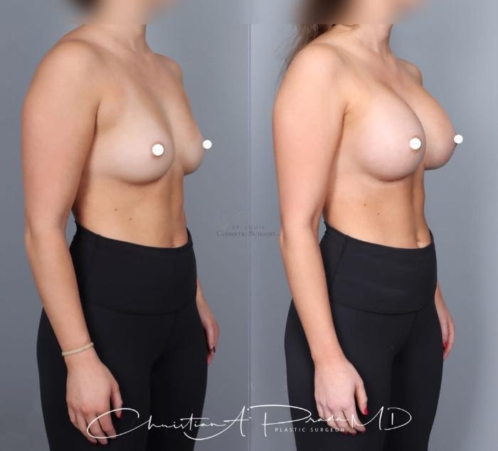 Before & After Breast Augmentation Case 430 Right Oblique View in St. Louis, MO