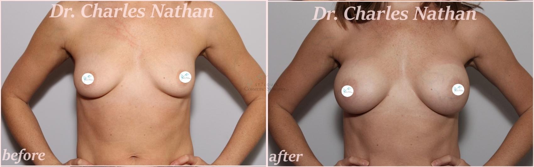 Before & After Breast Augmentation Case 431 Front View in St. Louis, MO