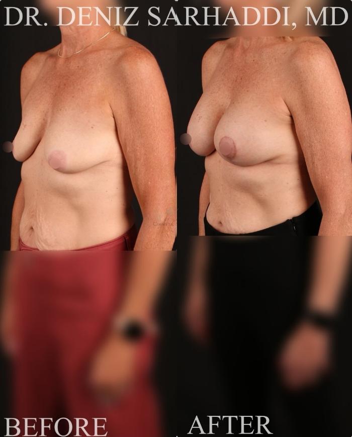 Before & After Breast Augmentation Case 433 Left Oblique View in St. Louis, MO