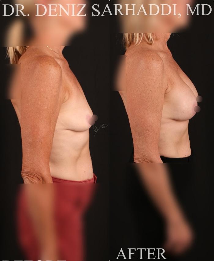 Before & After Breast Augmentation Case 433 Right Side View in St. Louis, MO