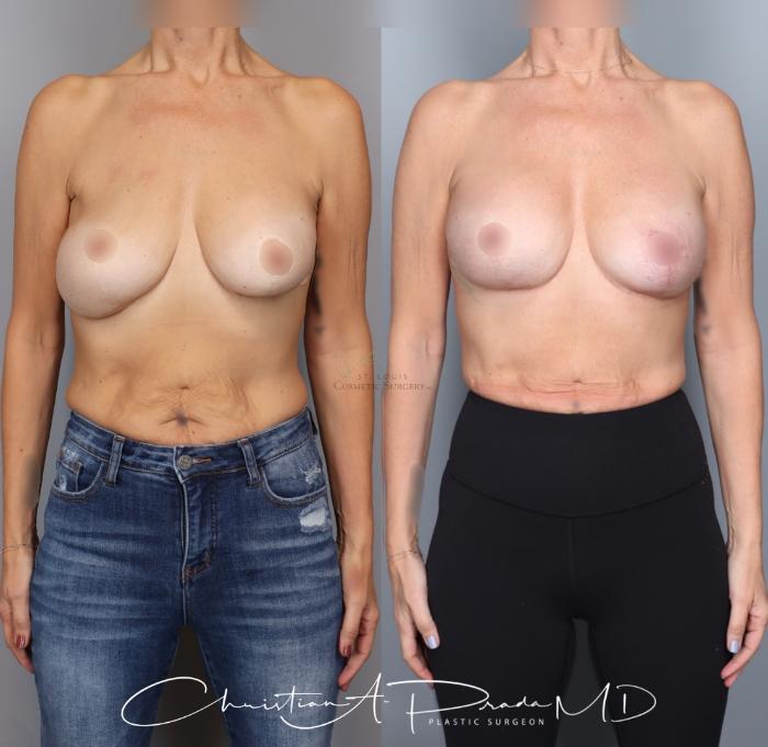 Before & After Breast Augmentation Case 434 Front View in St. Louis, MO