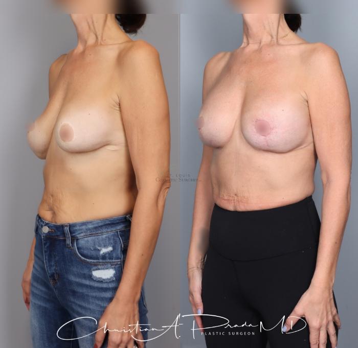 Before & After Breast Augmentation Case 434 Left Oblique View in St. Louis, MO