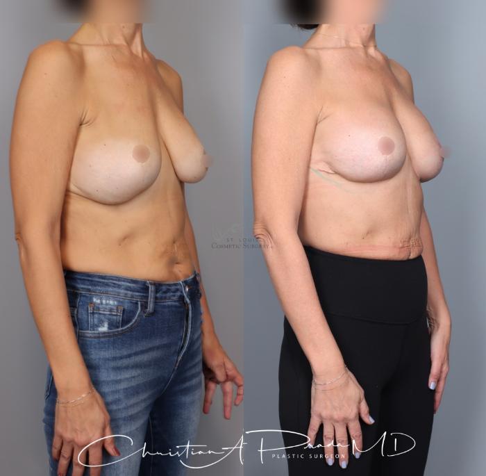Before & After Breast Augmentation Case 434 Right Oblique View in St. Louis, MO