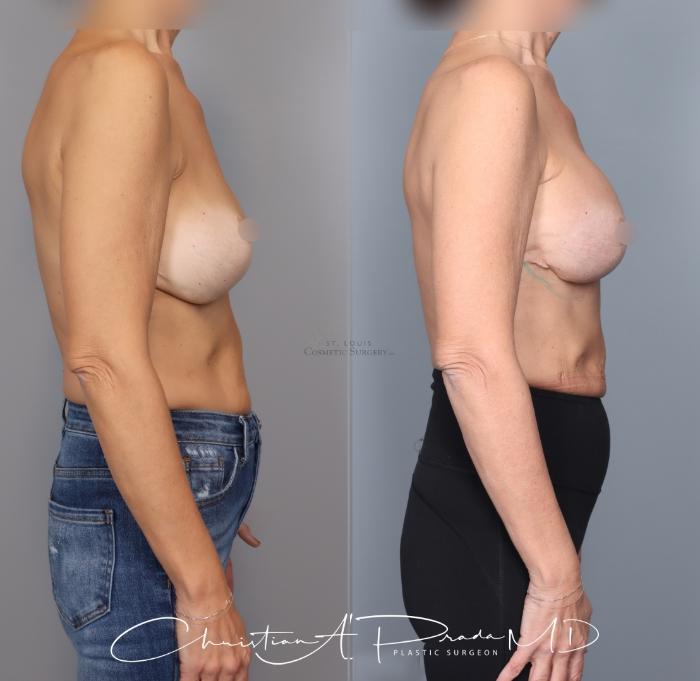 Before & After Breast Augmentation Case 434 Right Side View in St. Louis, MO