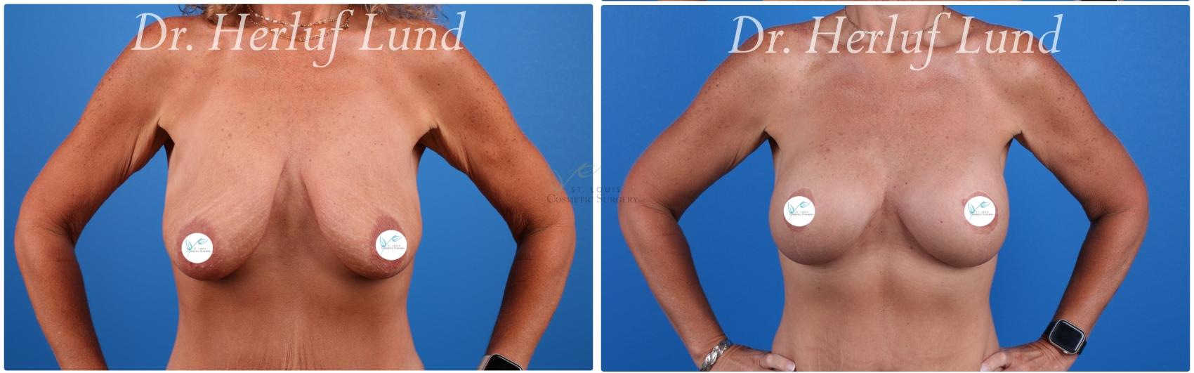 Before & After Breast Augmentation Case 442 Front View in St. Louis, MO