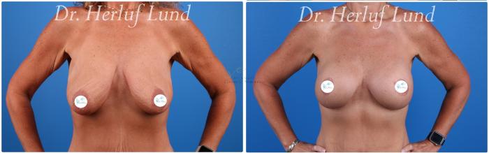 Before & After Breast Augmentation Case 442 Front View in St. Louis, MO
